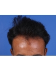 Before Hair Transplant&nbsp;Front